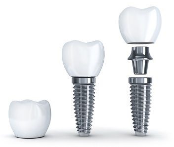 dental implants painless